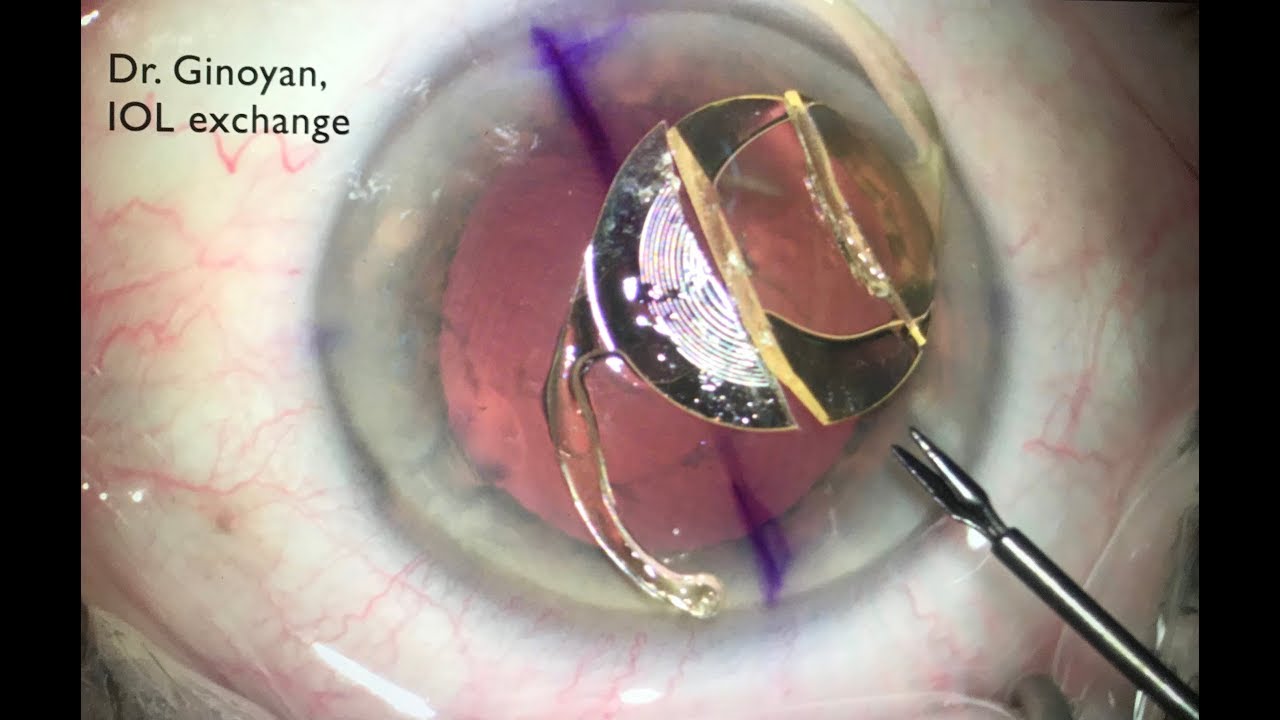 Замена искусственного хрусталика / IOL exchange