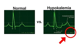 Hypokalemia ECG | Normal vs Hypokalemia | ECG changes in Hypokalemia #ecg #hypokalemia #cardiology