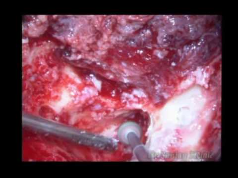 Video: Nese- Og Bihulekreft (Squamous Cell Carcinoma) Hos Katter