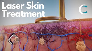 Next Generation Laser Treatment of Skin Lesions and Pigmentation  by Candela  3D medical animation)