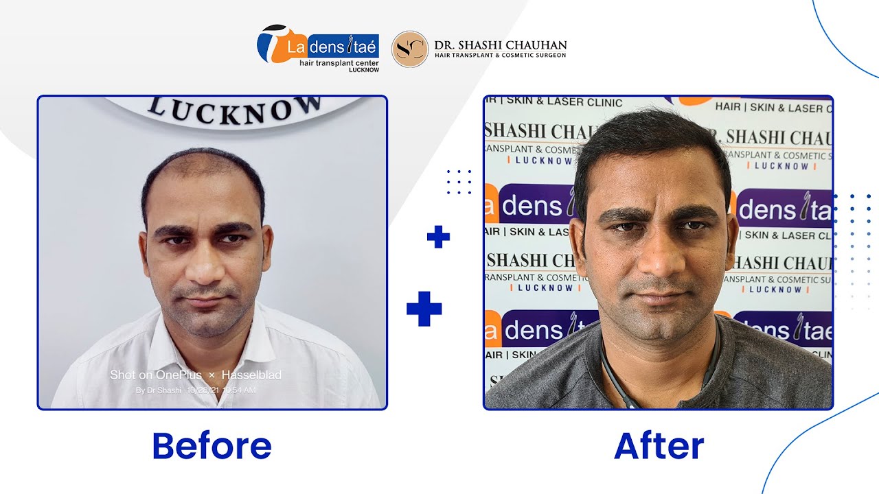 Best Hair Transplant Clinic in Lucknow  Plastic  Cosmetic Surgery