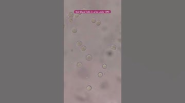Red blood cell in urine under the microscope #laboratory #medtechstudent #mls #cls #urinesediment #m