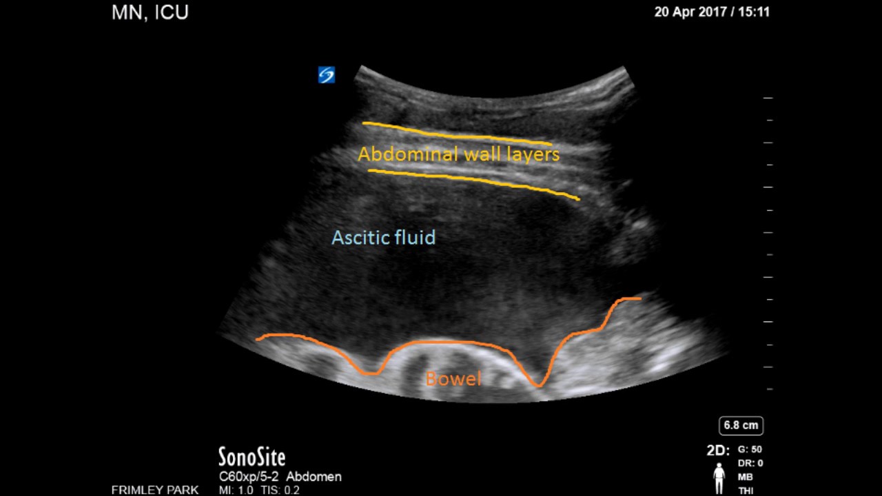 Ascites In Abdomen