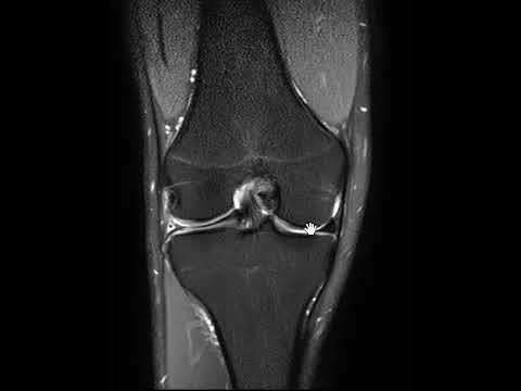 تمزق الغضروف الهلالي لمقبض الدلو