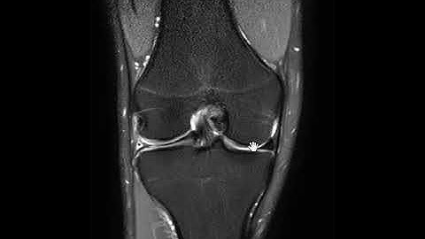 Bucket handle tear meniscus