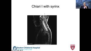 Chiari I as an Incidental Finding  Ask the Expert featuring Dr. Mark Proctor