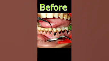 Tambaku Ke Dant Kaise Saaf Karen Teeth Tobacco Stain Removal Shorts 