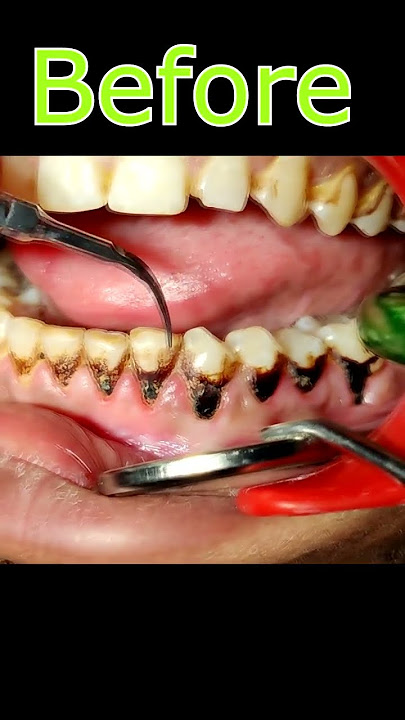 tambaku ke dant kaise saaf karen | teeth tobacco stain removal #shorts