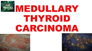 MEDULLARY THYROID CARCINOMA : Gross, Microscopic & Clinical features by ilovepathology 6,045 views 4 months ago 12 minutes, 16 seconds