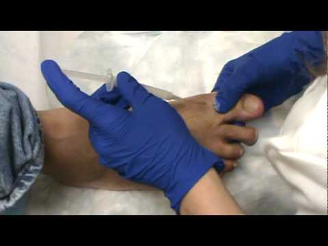 Steroid injections for arthritis in foot