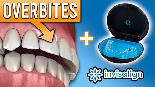 Can Invisalign FIX Overbites & Other Bite Problems? | Premier Orthodontics