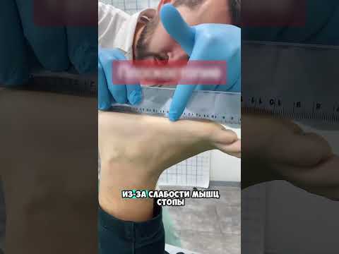 Как избежать плоскостопия 😮