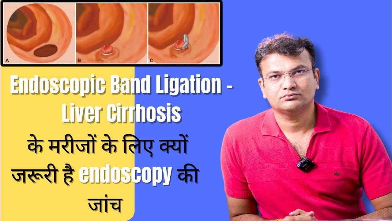 Endoscopic Band Ligation Liver Cirrhosis के मरीजों के लिए क्यों जरूरी
