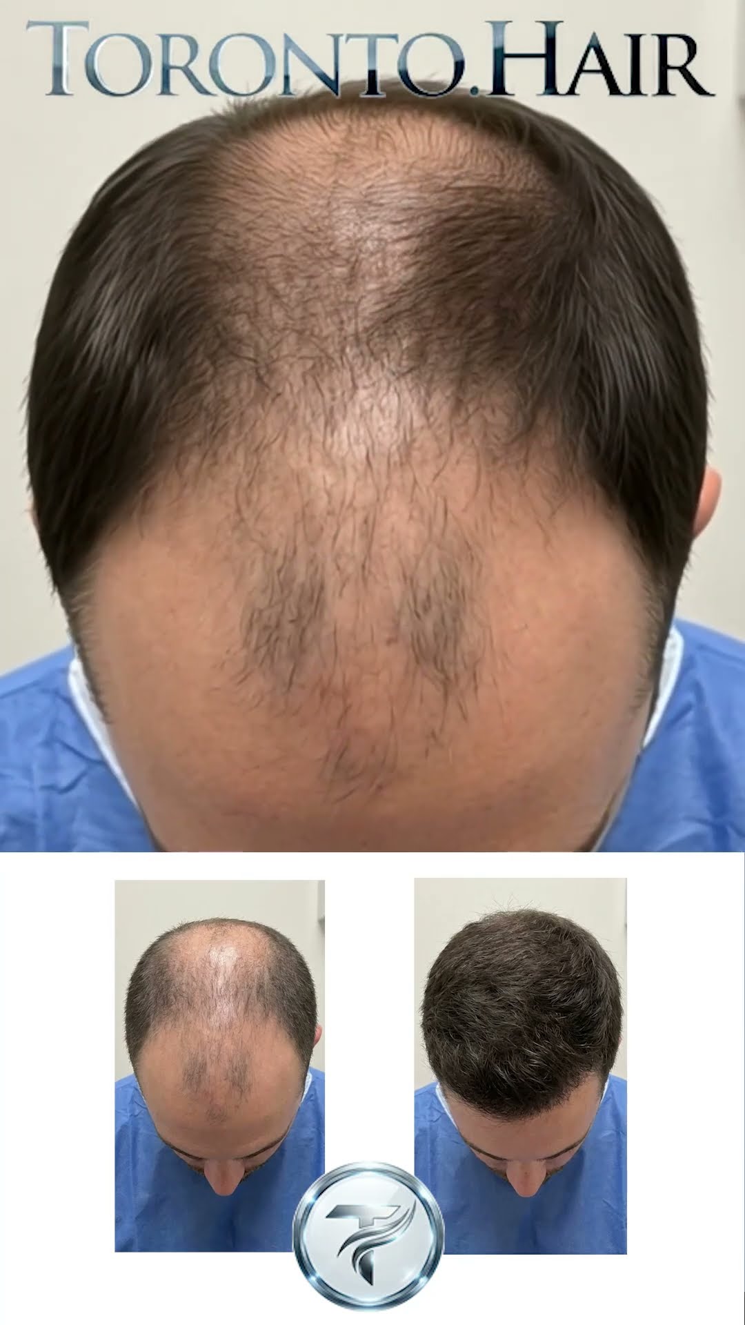 Hair transplants, explained