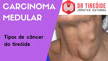 O que é carcinoma medular da tireoide?