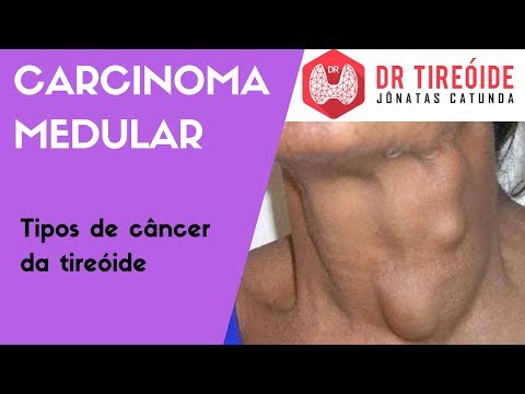 Vídeo: O carcinoma medular pode se espalhar?