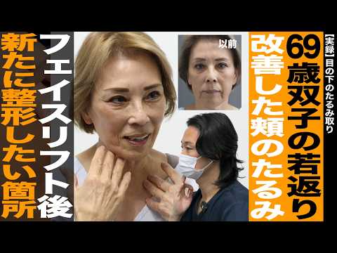 【実録】69歳双子姉妹の若返り！フェイスリフト後に新たな整形とは？┃目の下のたるみ取り【ドクターA（麻生泰）】