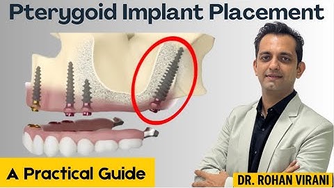 🦷 Mastering Pterygoid Implants: A Step-by-Step Surgical Guide 🔍