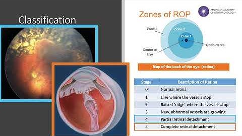Retinopathy of Prematurity