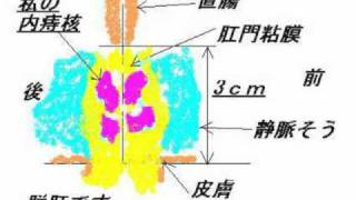 【初音ミクｘグラインドコア】アナルとか脱肛の話(miku hatsune sing Grind core "ANAL & ANAL")