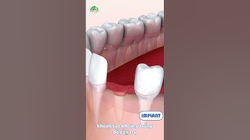 🎞 Mô phỏng quá trình cấy ghép Implant