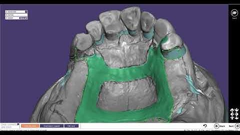partial frame design using EXOCAD(A-P bar) from Korea