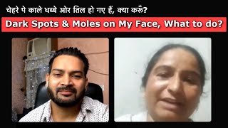 Dark Spots & Moles on My Face, What to do चेहरे पे काले धब्बे ओर तिल हो गए हैं, क्या करूँ