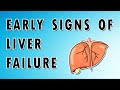 Ascites, Varices, Edema, Anorexia - Signs of Liver Failure (Fatty Liver and Alcoholic Hepatitis)