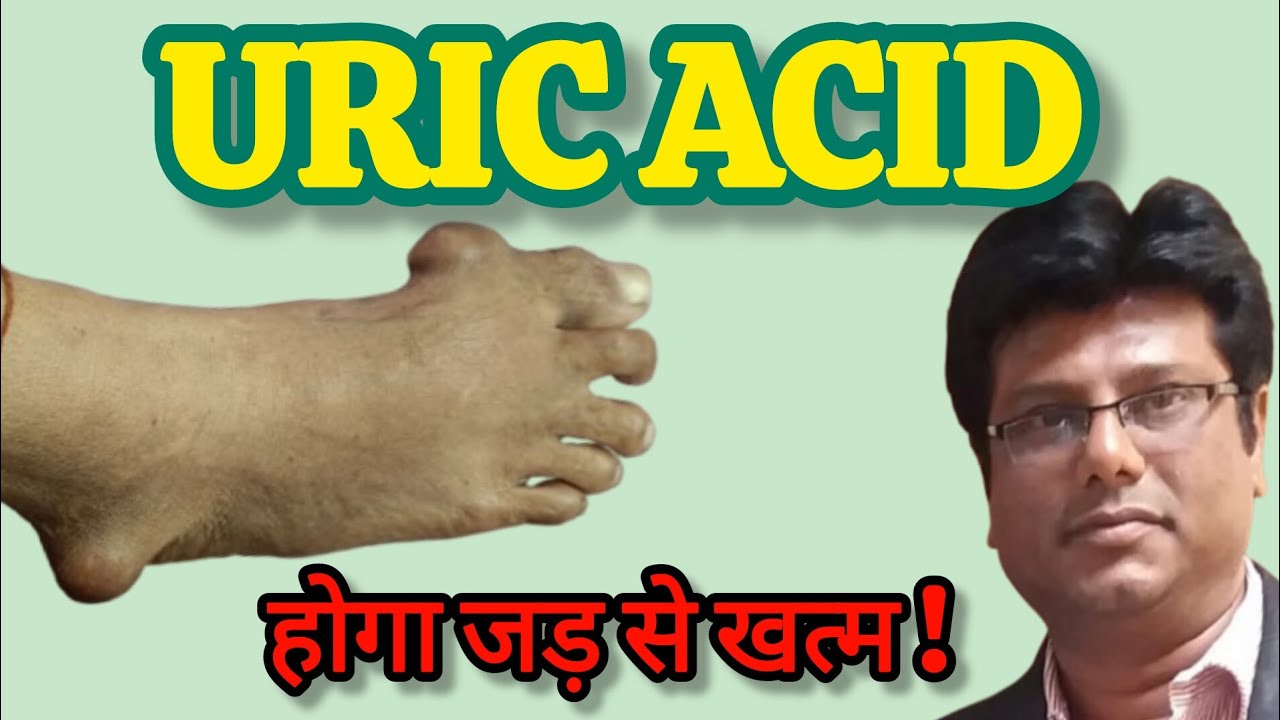 Uric Acid kabhi nahi badhega ! Home remedies | Diet Plan for Uric acid.
