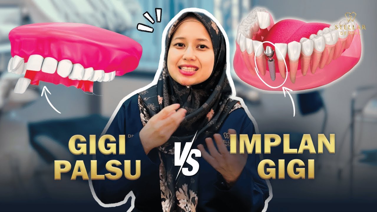 Gigi Palsu VS Implan Gigi: 6 Perbezaan Besar
