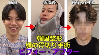 【韓国整形】顎の骨切り・オトガイ整形体験記・整形ビフォーからダウンタイム1か月後までの記録 ミニVライン形成 輪郭3点