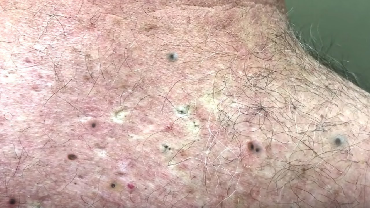 Remove Blackheads On Back How To Remove Blackheads On Back YouTube
