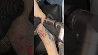 Качественная процедура лазерного удаления татуировки на предплечье в Пушкине СПб