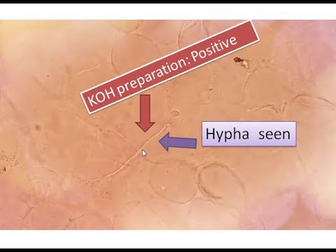 KOH positive | Fungal elements seen | Sputum  | hyphae