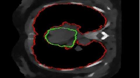 Segmentation Lung and Heart
