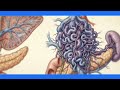 Cavernous Transformation of the Portal Vein | Ultrasound, color Doppler Features, Early Cirrhosis