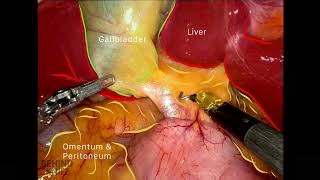 Behind The Knife - Robotic Cholecystectomy
