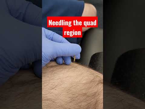 Dry Needling for