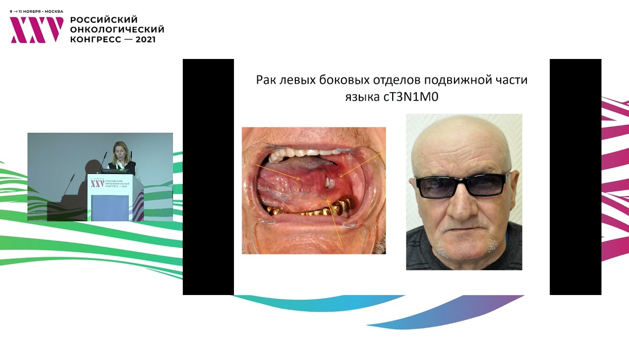 Рак слизистой оболочки полости рта. Реконструкция дефекта языка ...