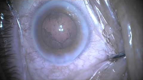 Cataract Surgery - Divide and Conquer