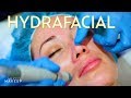 What is a Hydrafacial Treatment + Our Review! | The SASS with Susan and Sharzad