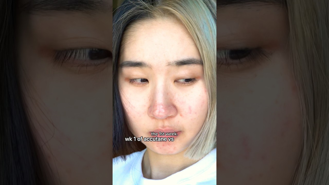 Week 3 of becoming acne free forever 