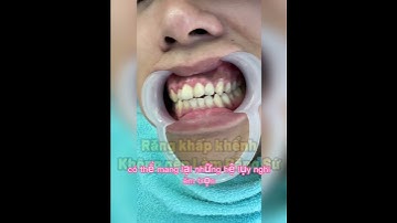 RĂNG KHẤP KHỂNH không nên LÀM RĂNG SỨ | không nên BỌC RĂNG SỨ khi RĂNG KHẤP KHỂNH