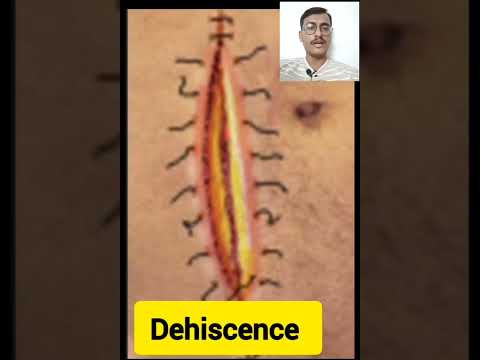 Video: Apakah dehiscence adalah istilah medis?