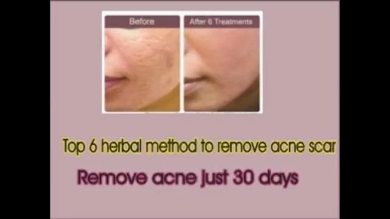 top 6 herbal acne scar treatment| natural| home remedy|face pack - YouTube