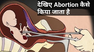 देखिए Abortion कैसे किया जाता है, Abortion and its type, Medical vs Surgical abortion