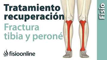 ¿Cuánto tiempo se tarda en recuperarse de una fractura de tibia y peroné?