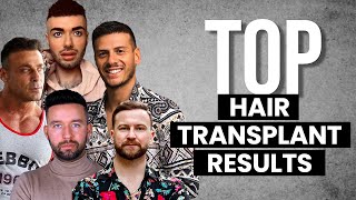 HAIR TRANSPLANT BEFORE AND AFTER | SMILE HAIR CLINIC PRESENTS: BEST RESULTS