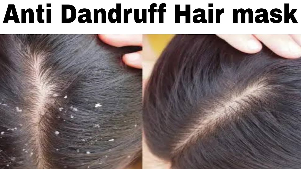 Home Treatments for Dandruff How to Treat Dandruff at Home Hair