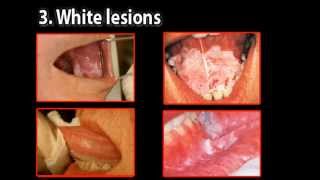 Oral Cancer - Could You Be A Risk?